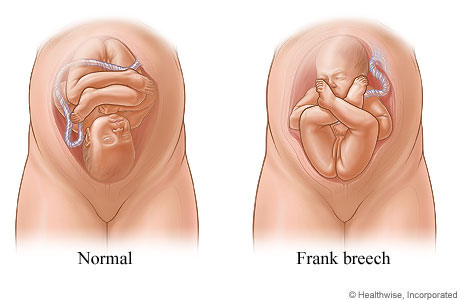 Normal and frank breech positions