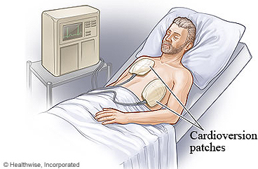 Electrical cardioversion treatment