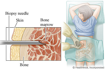 Picture of the facedown position for a bone marrow aspiration and biopsy