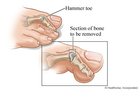 Hammer toe and the section of bone to be removed