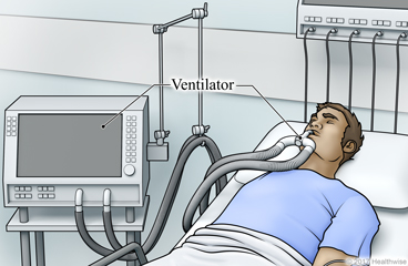Patient with ventilator, in hospital bed