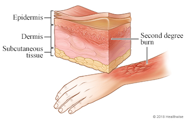 Picture of a second-degree burn on the arm