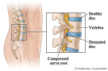 Compressed nerve