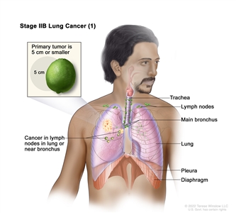 Stage IIB lung cancer (1); drawing shows a primary tumor (5 cm or smaller) in the right lung and cancer in lymph nodes in the same lung as the primary tumor. Also shown are the trachea, main bronchus, pleura, and diaphragm.