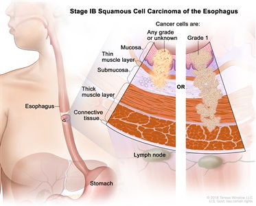 Stage IB squamous cell carcinoma of the esophagus; drawing shows the esophagus and stomach. A two-panel inset shows the layers of the esophagus wall: the mucosa layer, thin muscle layer, submucosa layer, thick muscle layer, and connective tissue layer. The lymph nodes are also shown. The left panel shows cancer cells that are any grade or of an unknown grade in the mucosa layer, thin muscle layer, and submucosa layer. The right panel shows grade 1 cancer cells in the mucosa layer, thin muscle layer, submucosa layer, and thick muscle layer.