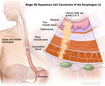 Stage IIB squamous cell carcinoma of the esophagus (1); drawing shows the upper and middle parts of the esophagus and the stomach. An inset shows grade 2 or 3 cancer cells in the mucosa layer, thin muscle layer, submucosa layer, thick muscle layer, and connective tissue layer of the upper and middle esophagus wall.