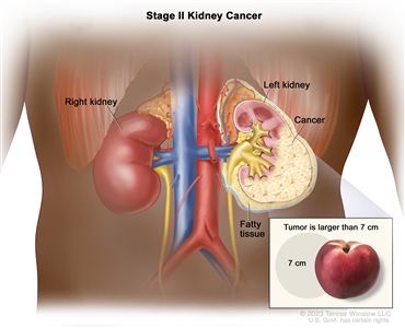 Stage II kidney cancer; drawing shows cancer in the left kidney and the tumor is larger than 7 centimeters. An inset shows 7 centimeters is about the size of a peach. Also shown are the fatty tissue and right kidney.