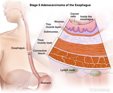 Stage 0 adenocarcinoma of the esophagus; drawing shows the esophagus and stomach. An inset shows cancer cells in the inner lining of the esophagus wall. Also shown are the mucosa layer, thin muscle layer, submucosa layer, thick muscle layer, and connective tissue layer of the esophagus wall. The lymph nodes are also shown.