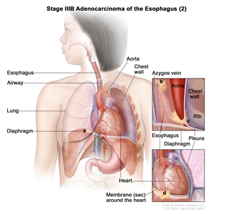 Stage IIIB adenocarcinoma of the esophagus (2); drawing shows cancer in the esophagus and in the (a) diaphragm, (b) azygos vein, (c) pleura, and (d) membrane (sac) around the heart. Also shown are the airway, lung, aorta, chest wall, heart, and rib.