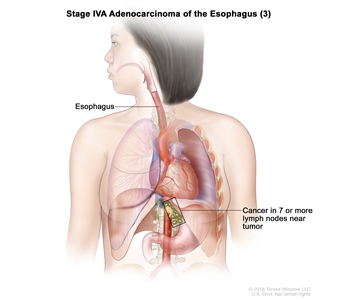Stage IVA adenocarcinoma of the esophagus (3); drawing shows cancer in the esophagus and in 9 lymph nodes near the tumor.