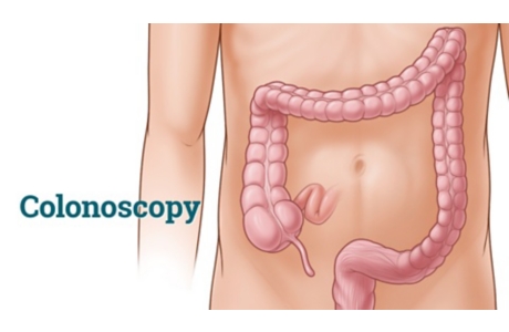 Colonoscopy: Overview
