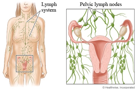 Lymph system throughout body, with close-up of lymph nodes in female pelvic area.