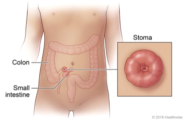 Location of the colon, small intestine, and stoma, with closeup view of the stoma