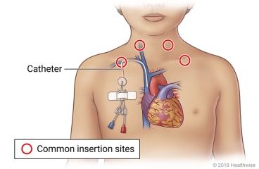 Common insertion sites for a tunneled catheter