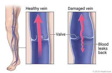 Leg veins, with detail of healthy vein and valve and of damaged vein that allows blood to leak backward