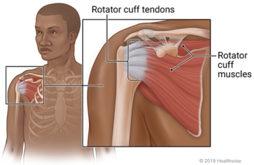 Rotator cuff around top of arm bone at shoulder, with close-up of rotator cuff tendons and muscles
