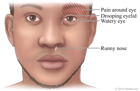 Face of person showing symptoms of a cluster headache