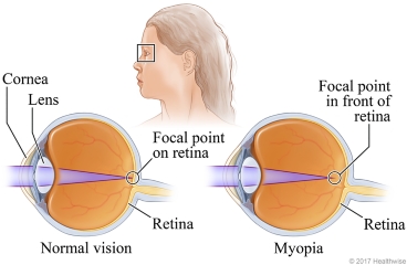 Cross-sections of eye with normal vision and eye with myopia