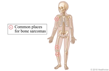 Common places for bone sarcomas, including above and below the knee and on the upper arm