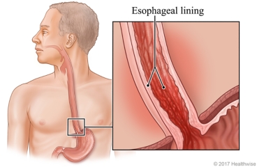Esophagus with detail of esophageal lining