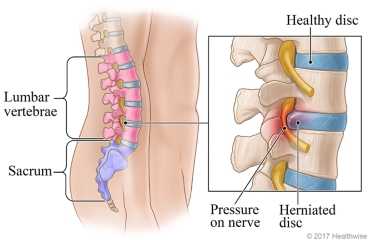 A healthy disc and a herniated disc