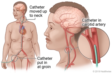 Catheter put into blood vessel at groin and moved up to neck, with detail of catheter in carotid artery in neck