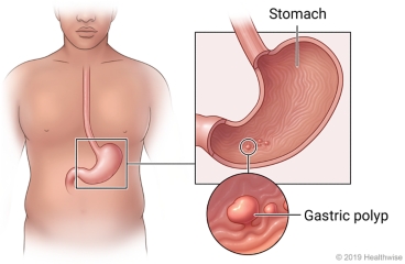 Location of stomach in upper belly, with detail of stomach lining with polyps and close-up of a gastric polyp
