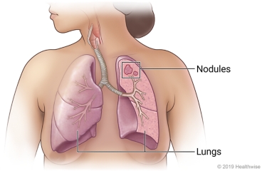 Lungs in chest, with two nodules in upper left lung