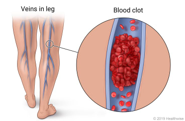 Back of person's legs showing veins in leg, with detail of blood clot inside vein.
