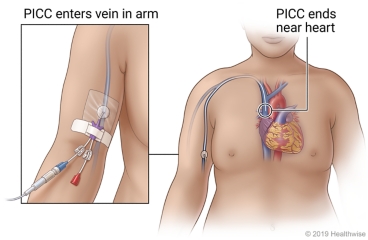 PICC line entering vein in arm above bend in elbow, ending near the heart