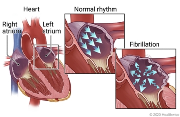 Inside view of right and left atria of heart, with details of normal rhythm and fibrillation in an atrium.