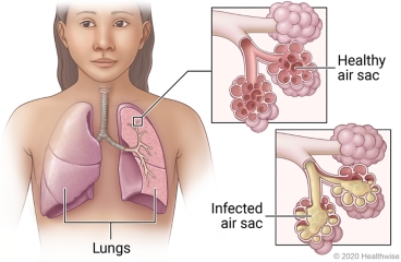 Lungs in chest showing airways, with detail of healthy air sac and infected air sac