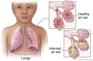 Lungs in child's chest showing airways, with detail of healthy air sac and infected air sac