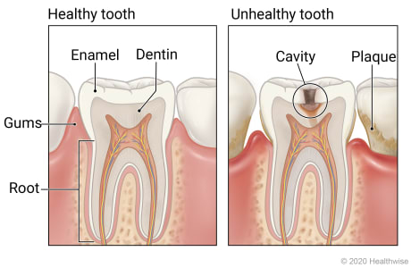Healthy tooth showing layers of enamel, dentin, and root, and unhealthy tooth with plaque showing cavity affecting layers of tooth.