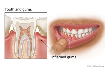 Mouth with inflamed gums, with detail showing inside a tooth surrounded by inflamed gums