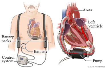 Location of VAD pump, battery packs, and controller, with detail of VAD pumping blood from heart's left ventricle to the aorta.