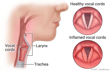 Larynx and trachea in neck showing vocal cords in larynx, with detail of healthy vocal cords and inflamed vocal cords.