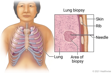 Lungs in chest, with detail of needle inserted between ribs to area of lung biopsy.