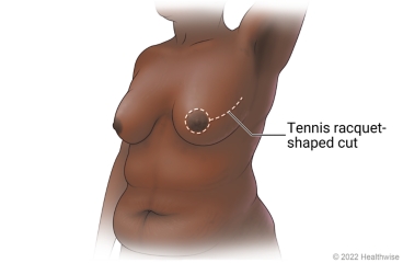 Breast showing incision site for skin-sparing mastectomy with tennis racquet-shaped cut around areola.