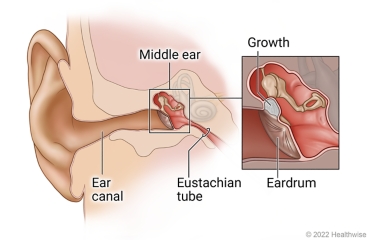 Anatomy of ear, showing ear canal, middle ear, and eustachian tube, with detail of growth behind eardrum in middle ear.