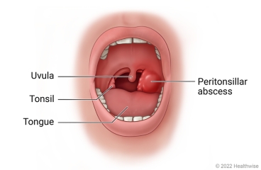 Open mouth and throat, showing tongue, tonsils, uvula, and peritonsillar abscess near tonsil.