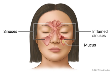 Sinuses in face around eyes and nose, showing clear sinuses on one side of face and inflamed sinuses with mucus buildup in a sinus on other side.
