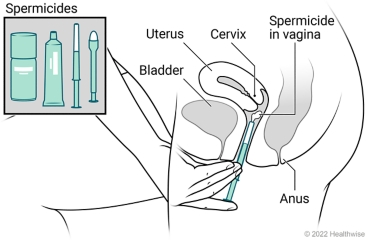 Female pelvic organs, showing a uterus, cervix, bladder, and anus, with detail of types of spermicides and spermicide placed in vagina.