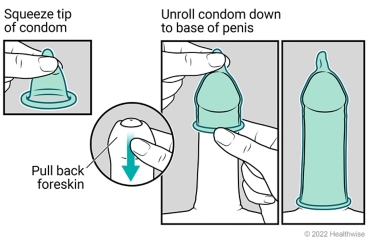 Rolled-up condom, foreskin of penis being pulled back, and external condom unrolled to base of erect penis.