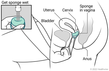 Female pelvic organs, showing a uterus, cervix, and bladder, with spermicide put in cervical cap and placed in vagina at cervix.