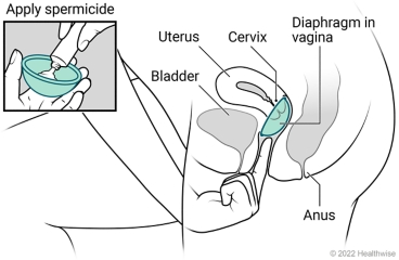 Female pelvic organs, showing a uterus, cervix, bladder, and anus, with spermicide applied to diaphragm and placed in vagina at cervix.