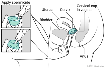 Female pelvic organs, showing a uterus, cervix, bladder, and anus, with spermicide put in cervical cap and placed in vagina at cervix.
