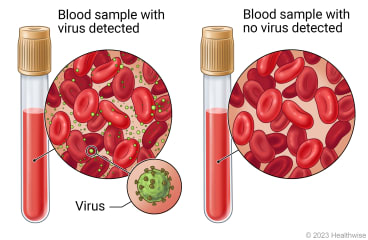 View through microscope of blood cells in blood samples, one with virus detected and one with no virus detected, and a closeup of virus.