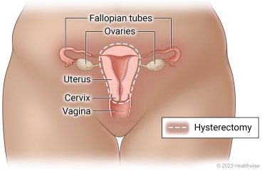 Female reproductive organs (fallopian tubes, ovaries, uterus, cervix, and vagina), showing uterus and cervix to be removed in hysterectomy.