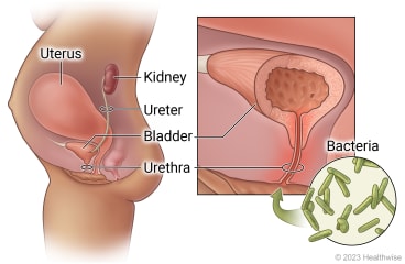 Side view of uterus and urinary tract during pregnancy, showing kidney, ureter, bladder, and urethra, with detail of bacteria entering urethra to bladder.